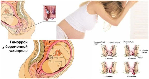 Симптомы геморроя на разных сроках беременности, лечение и профилактика