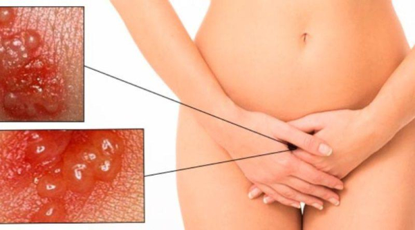 Симптомы генитального герпеса и чем он опасен при беременности, лечение